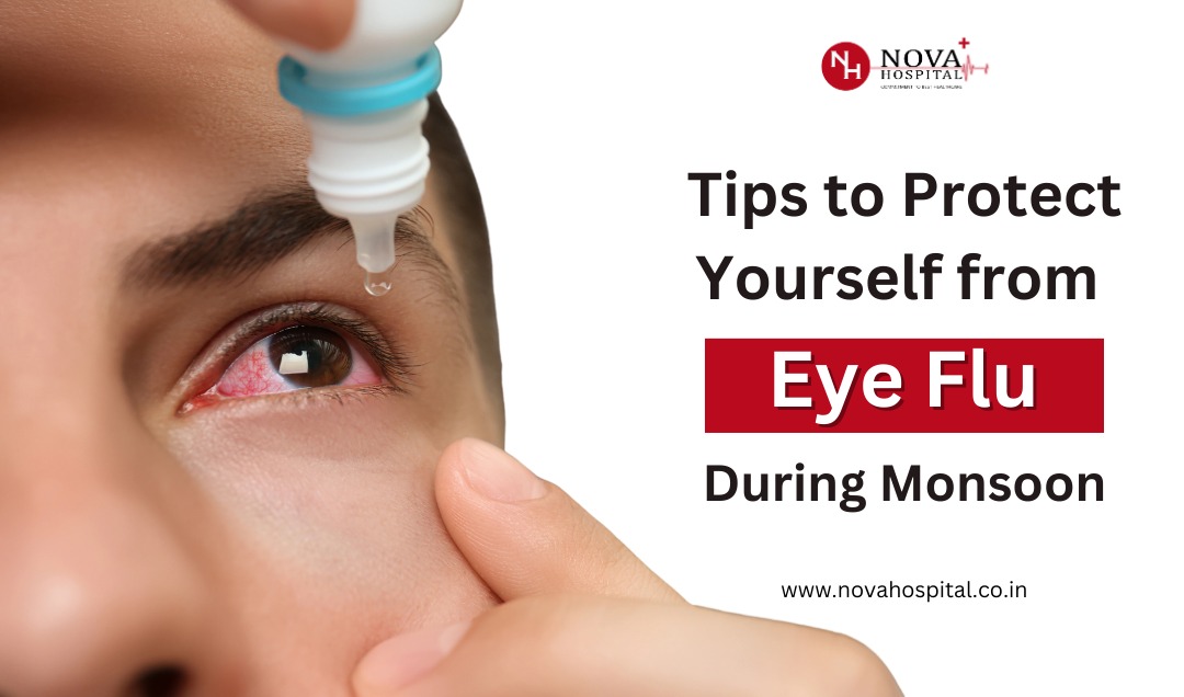 Tips To Protect Yourself From Eye Flu This Monsoon Nova Hospital